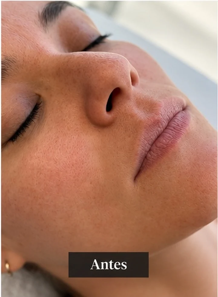 Labios antes del tratamiento